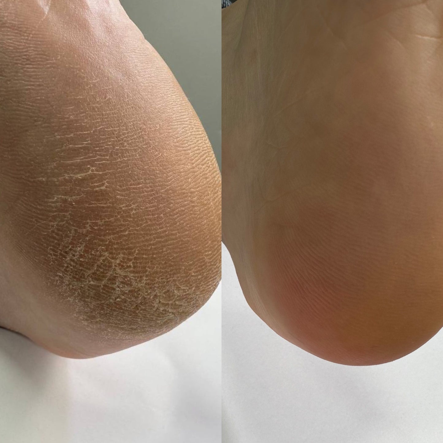 Nailsoftheday Podology+ KERATOLÍTICO para pies, 100 ml